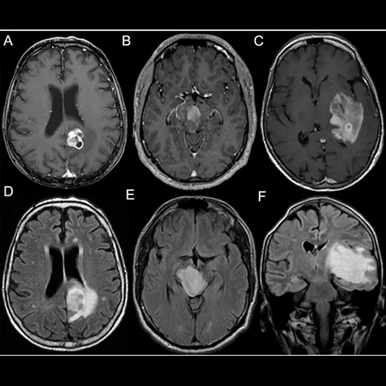 cerebral astrocytoma
